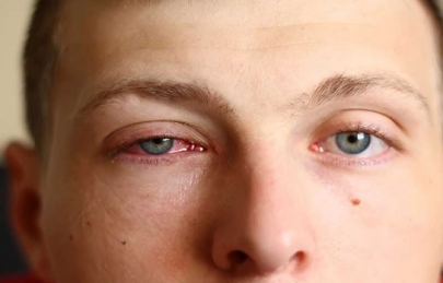 Viêm kết giác mạc cấp